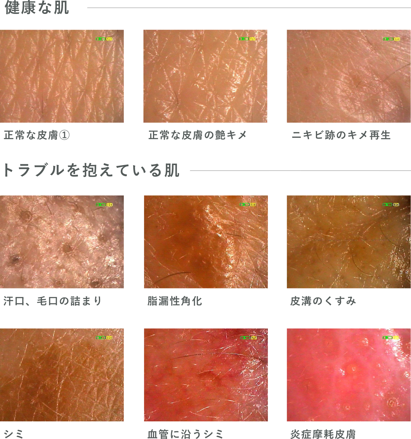 健康な肌とトラブルを抱えている肌の例